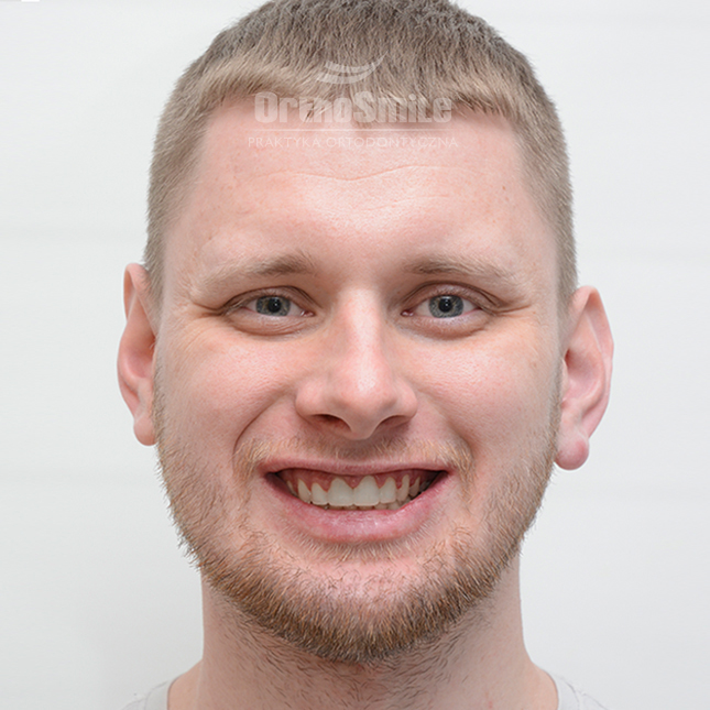 1METAMORFOZY_FOTO_OPERACYJNI_01-1_PRZED-PO_2