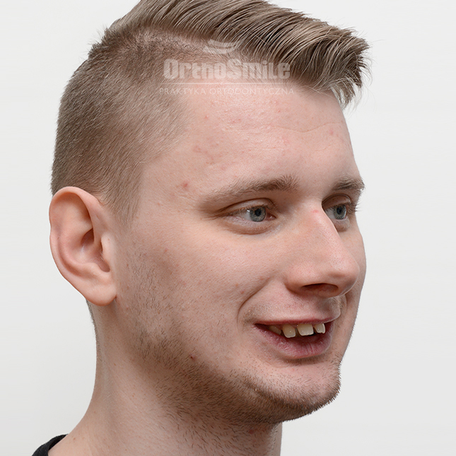 1METAMORFOZY_FOTO_OPERACYJNI_01-2_PRZED-PO_1