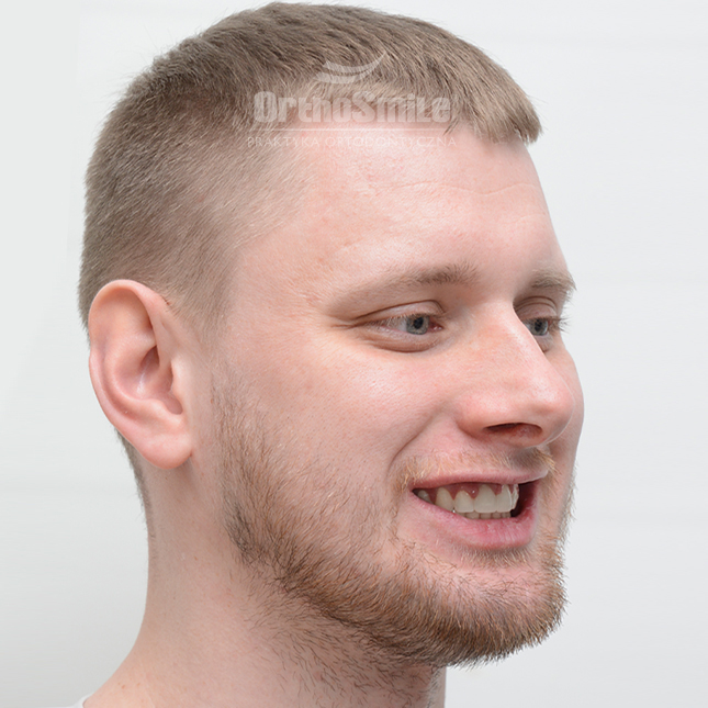 1METAMORFOZY_FOTO_OPERACYJNI_01-2_PRZED-PO_2