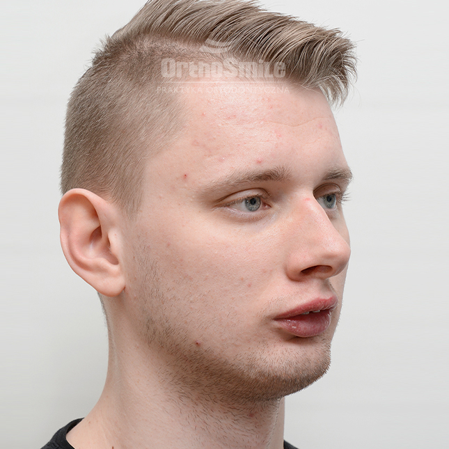 1METAMORFOZY_FOTO_OPERACYJNI_01-4_PRZED-PO_1