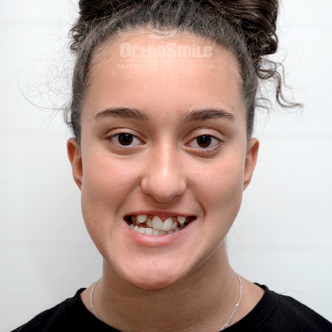 METAMORFOZY_FOTO_KOREKTA_PRZED-PO_operacyjne-2