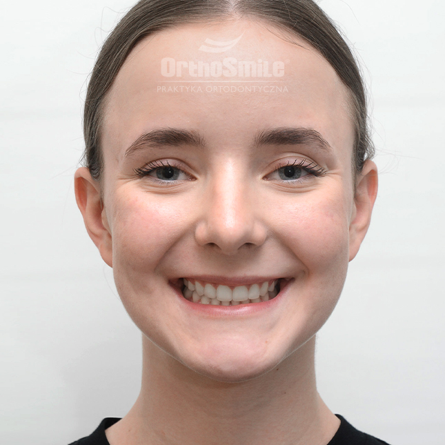 METAMORFOZY_FOTO_KOREKTA_PRZED-PO_wczesne_2