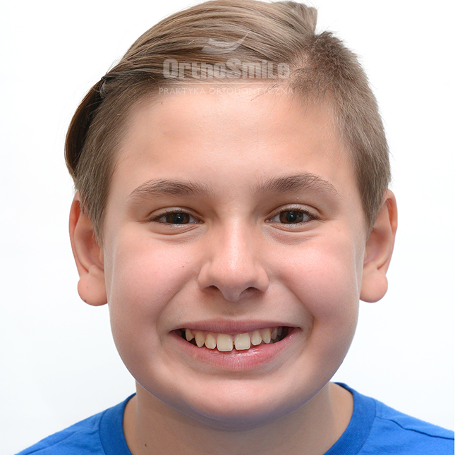 METAMORFOZY_FOTO_MLODZIEZ_01_PRZED-PO_1