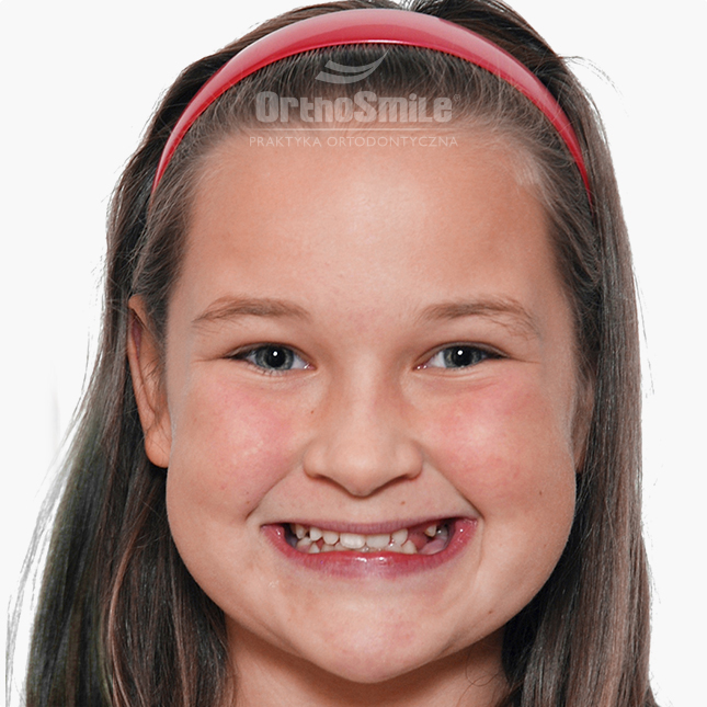 SEKCJA 5 - FOTO-WIGET_autotransplantacja_PRZED-PO-_2-2